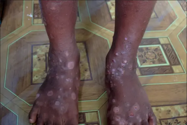 Scabies is a public health problem in Solomon Islands which affects mostly children of school age.