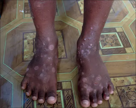 Scabies is a public health problem in Solomon Islands which affects mostly children of school age.