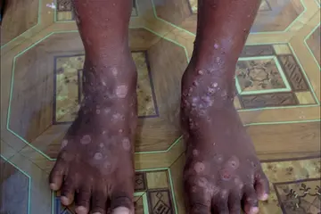 Scabies is a public health problem in Solomon Islands which affects mostly children of school age.