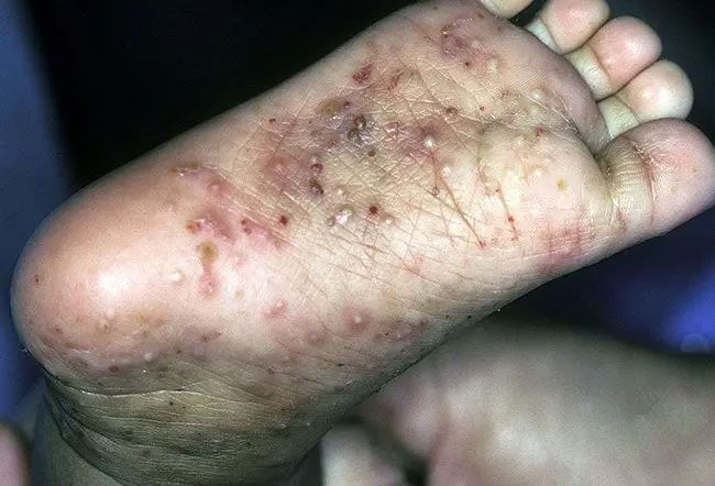 The nationwide MDA is recommended following a scabies prevalence survey conducted in 2021 that reported more than 23% of the Solomon Islands population live with scabies in the communities.