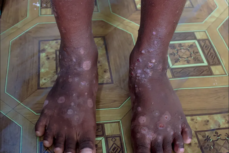 Scabies is endemic in the Solomon Islands and according to last year’s survey conducted in 10 villages in all the province, the prevalence rate for scabies is as high as 72 percent.
