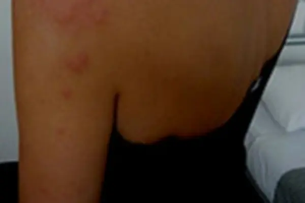 Unconfirmed reports states that Doctors suspect that the illness is due to meningococcal septicemia. Meningococcal septicemia, which is characterized by rapid circulatory collapse and a hemorrhagic rash, is a more severe, but less common, form of meningococcal disease.