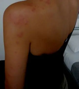 Unconfirmed reports states that Doctors suspect that the illness is due to meningococcal septicemia. Meningococcal septicemia, which is characterized by rapid circulatory collapse and a hemorrhagic rash, is a more severe, but less common, form of meningococcal disease.