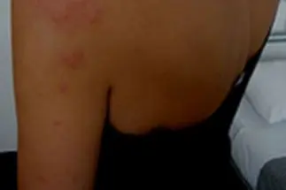 Unconfirmed reports states that Doctors suspect that the illness is due to meningococcal septicemia. Meningococcal septicemia, which is characterized by rapid circulatory collapse and a hemorrhagic rash, is a more severe, but less common, form of meningococcal disease.