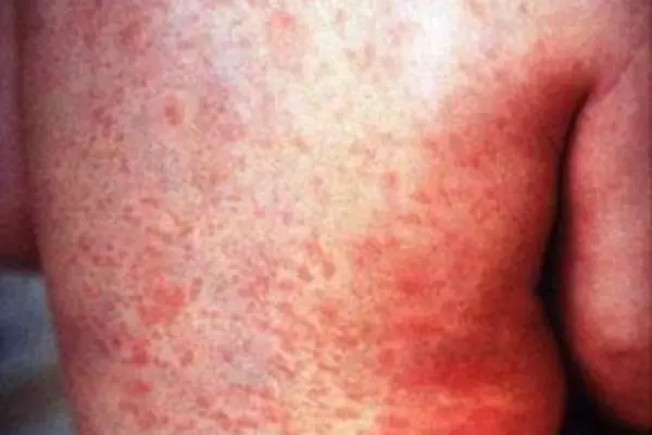 A young child with Rubella.