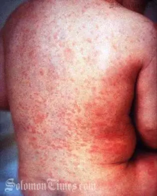 A young child with Rubella.