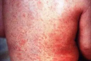 A young child with Rubella.