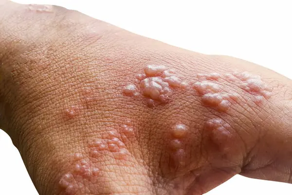 Early symptoms of monkeypox will be followed by a rash of fluid-filled blisters in one to three days.
