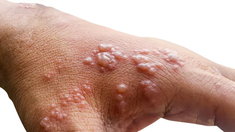 Early symptoms of monkeypox will be followed by a rash of fluid-filled blisters in one to three days.