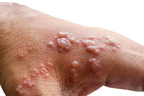 Early symptoms of monkeypox will be followed by a rash of fluid-filled blisters in one to three days.