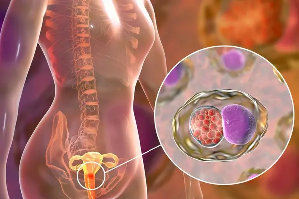 The World Health Organization (WHO) states that currently in the Solomon Islands cervical cancer is the second most common cause of cancer related deaths.
