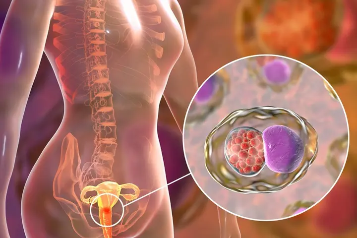 The World Health Organization (WHO) states that currently in the Solomon Islands cervical cancer is the second most common cause of cancer related deaths.