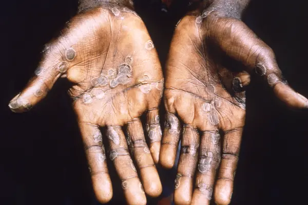 The declaration is important to notify countries around the world including those without a history of Monkeypox like the Solomon Islands to start planning and taking actions to mitigate the potential importation, spread, and impact of Monkeypox.