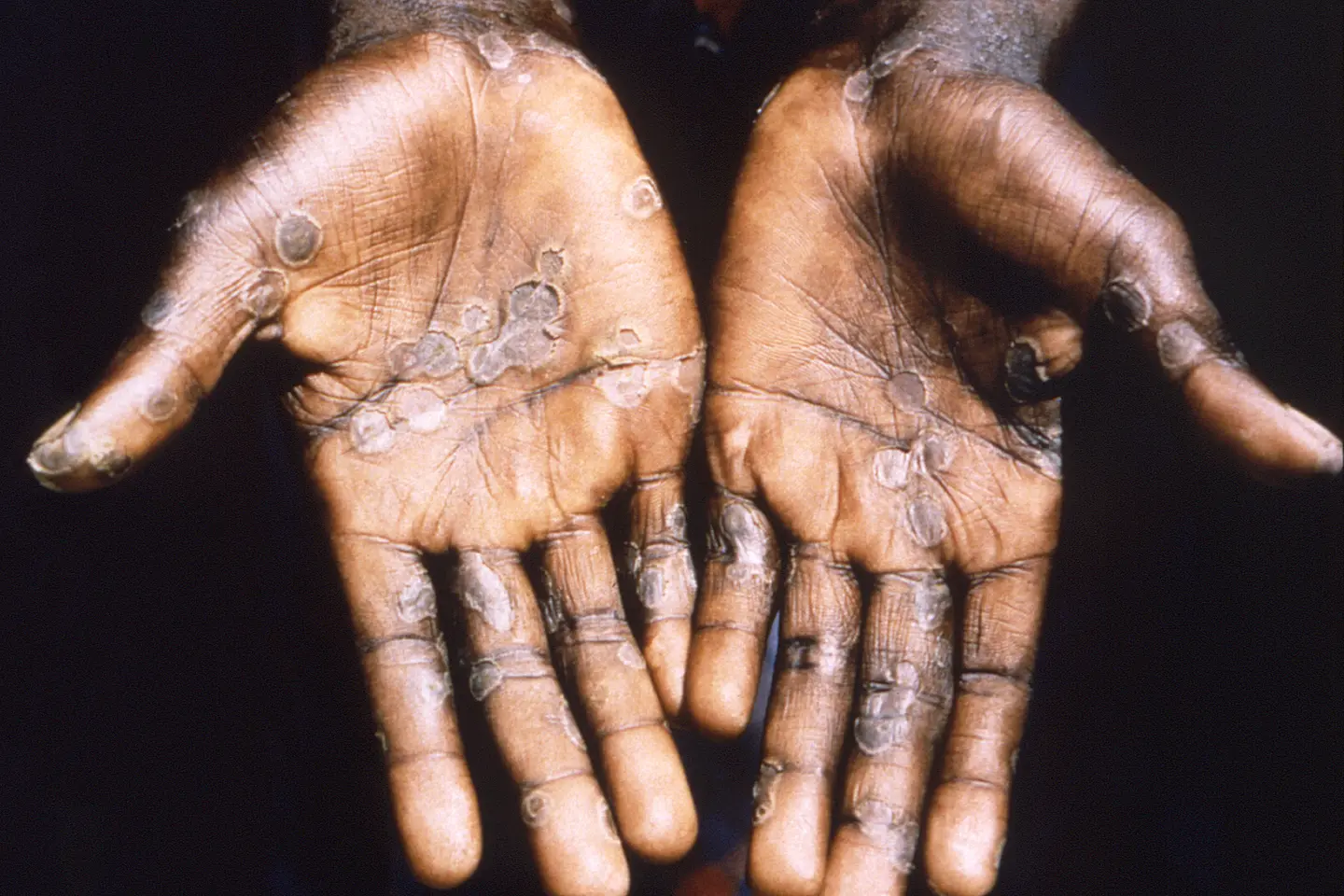 The declaration is important to notify countries around the world including those without a history of Monkeypox like the Solomon Islands to start planning and taking actions to mitigate the potential importation, spread, and impact of Monkeypox.