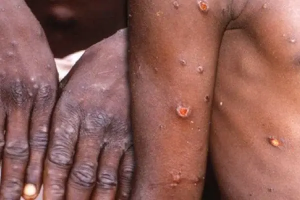 Those infected with monkeypox will typically experience a fever, intense headache, muscle aches, back pain, low energy, swollen lymph nodes and a skin rash or lesions. The rash usually begins within one to three days of the start of a fever. Number of lesions can range between a few to several thousands.