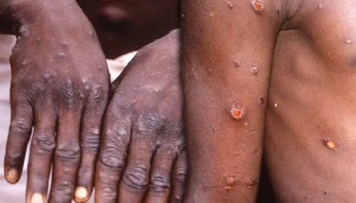 Those infected with monkeypox will typically experience a fever, intense headache, muscle aches, back pain, low energy, swollen lymph nodes and a skin rash or lesions. The rash usually begins within one to three days of the start of a fever. Number of lesions can range between a few to several thousands.